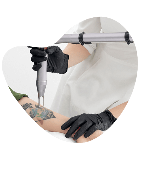 centros-especializados-en-remocion-de-tatuajes.png