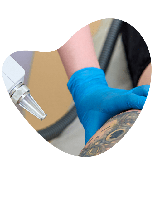 eliminacion-de-tatuajes-con-laser.png