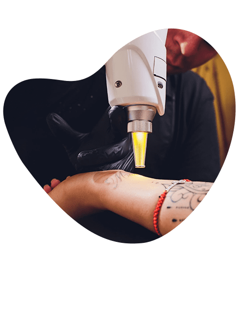 tratamiento-privado-de-eliminacion-de-tatuajes.png
