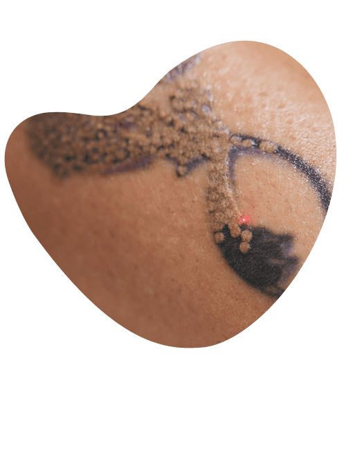 tratamientos-laser-para-tatuajes.png
