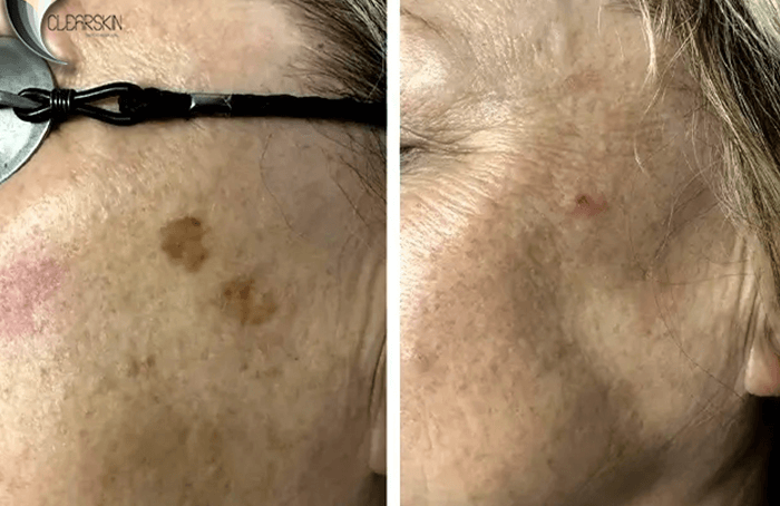 Eliminación de manchas cutáneas y/o melasmas